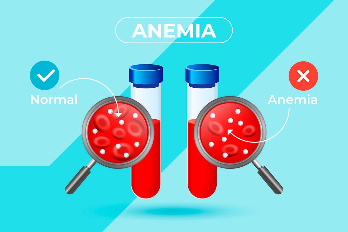 anemia infograpic