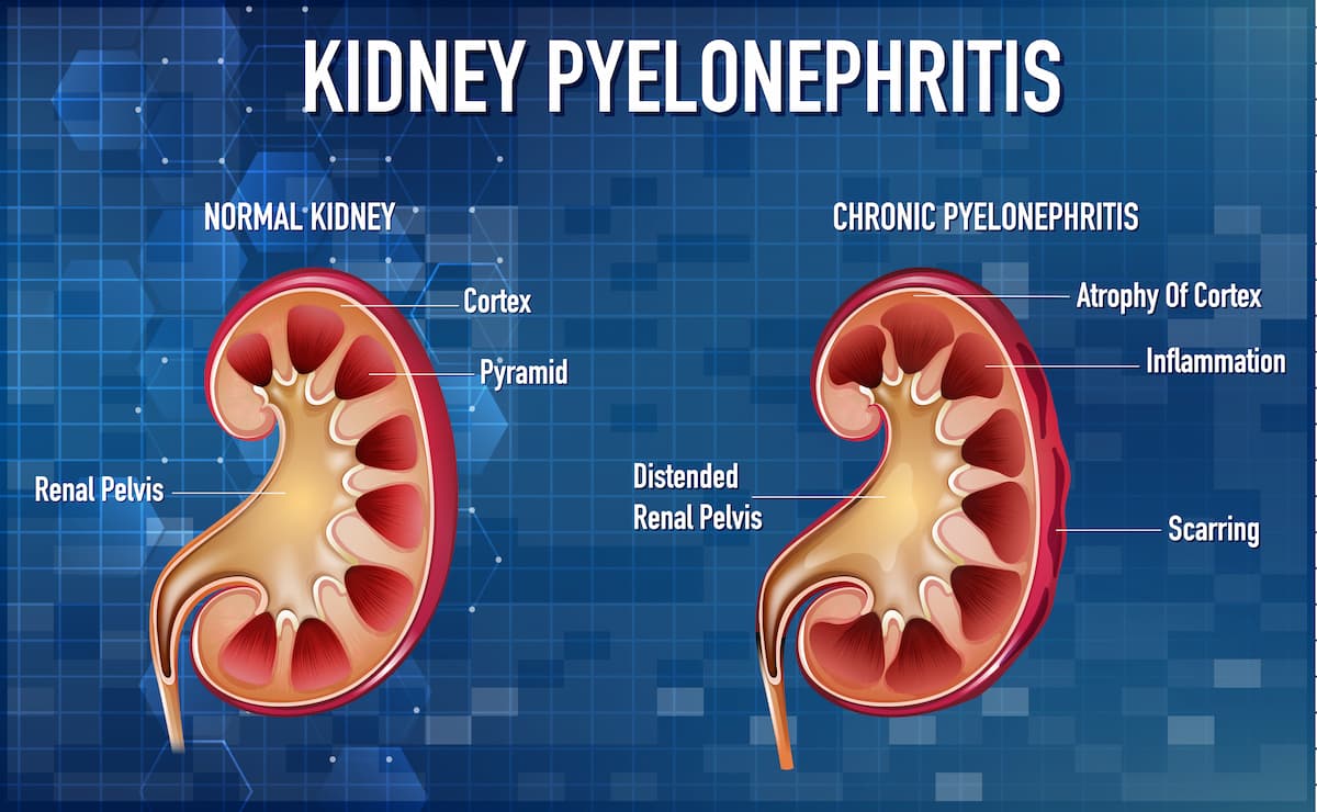 gambar kidney pyelonephritis