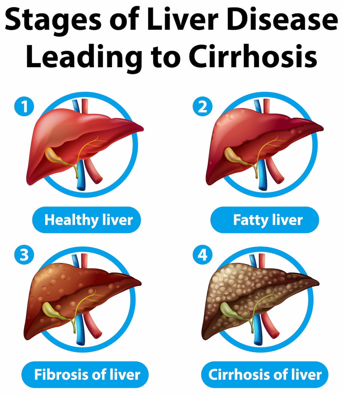 infograpic stage of liver deseases leading to Sirosis hati